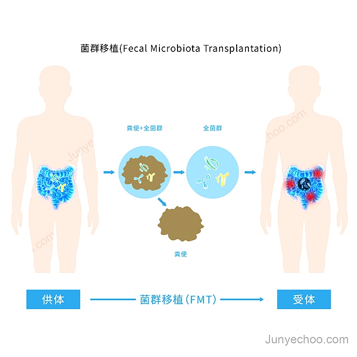 菌群移植